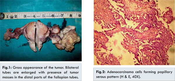 Bilateral Primary Fallopian Tube Carcinoma A